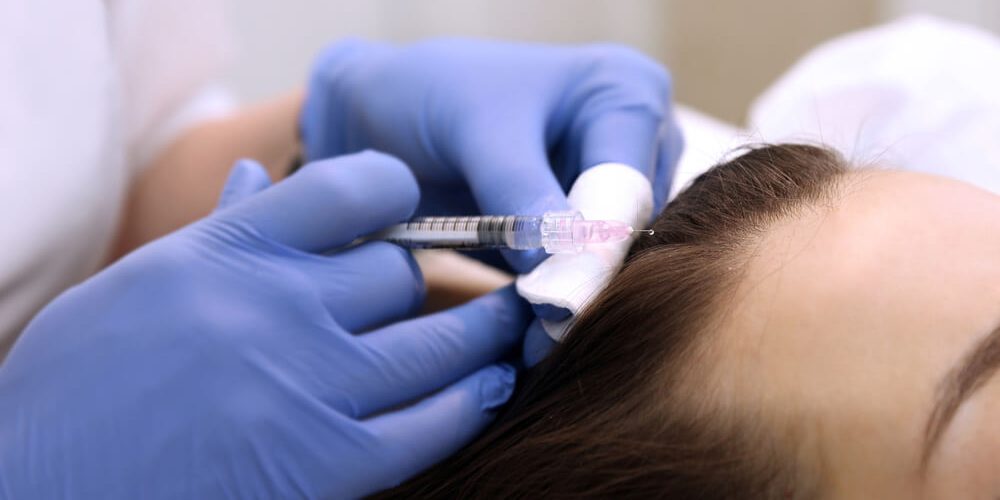 Mezoterapia igłowa głowy – ratunek dla włosów słabych i wypadających