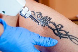 Niechciany tatuaż – i co dalej?